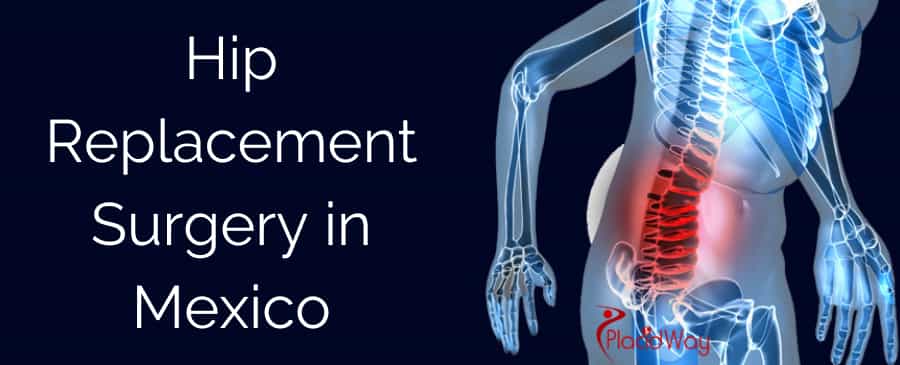 Hip Replacement Surgery in Mexico