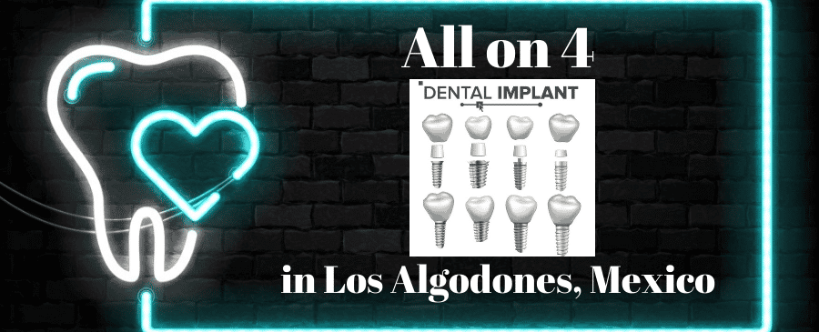 All on 4 Dental Implants in Los Algodones Mexico