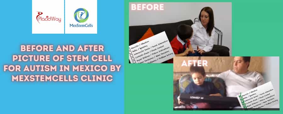 Before and After Picture of Child Stem Cell Treatment in Mexico City