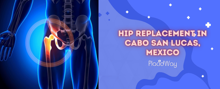 Hip Replacement in Cabo San Lucas, Mexico