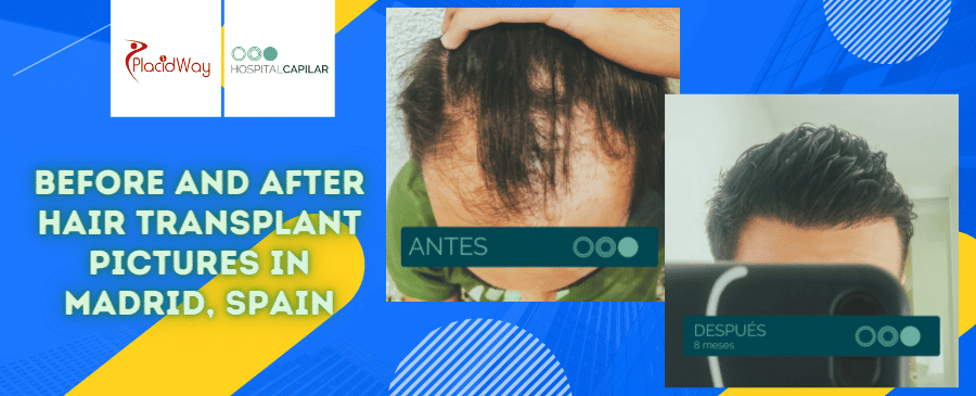 Hair Restoration in Hospital Capilar