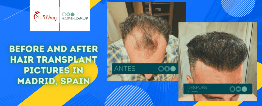 Hair Transplant in Hospital Capilar