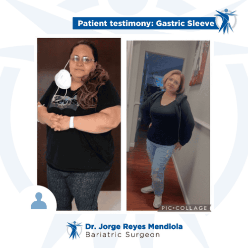 Before and After Pictures of Gastric Sleeve in Tijuana