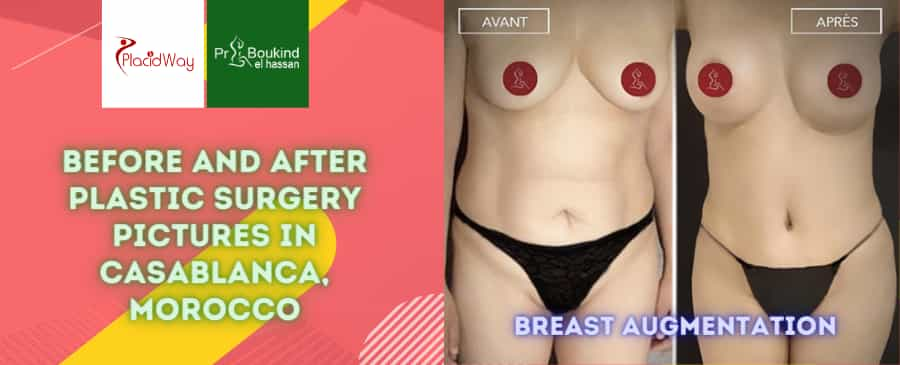 Before and After Plastic Surgery Pictures in Casablanca, Morocco