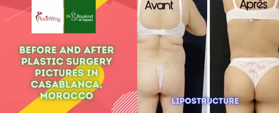 Before and After Plastic Surgery Pictures in Casablanca, Morocco