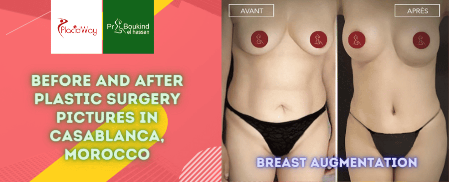 Before and After Plastic Surgery Pictures in Casablanca, Morocco