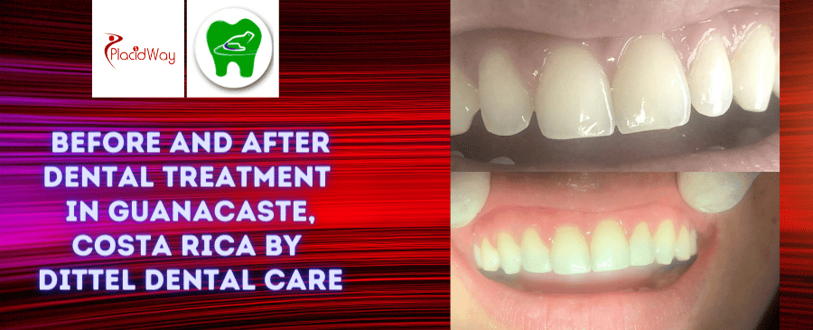 Before and After Dental Treatment Pictures in Guanacaste, Costa Rica