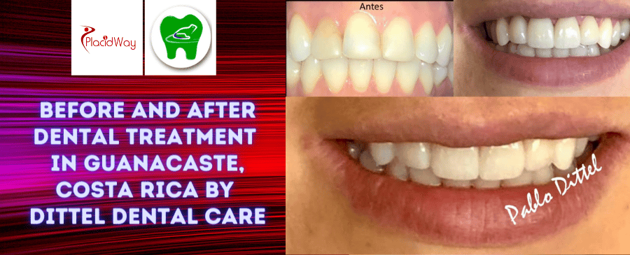 Before and After Dental Treatment Pictures in Guanacaste, Costa Rica