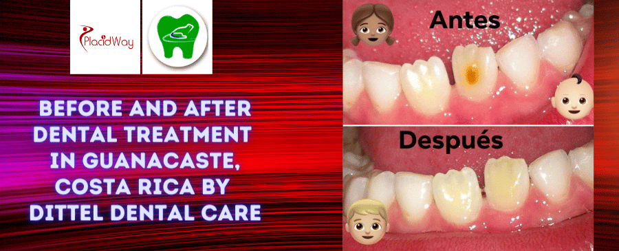 Before and After Dental Treatment Pictures in Guanacaste, Costa Rica