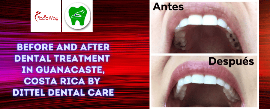 Before and After Dental Treatment Pictures in Guanacaste, Costa Rica