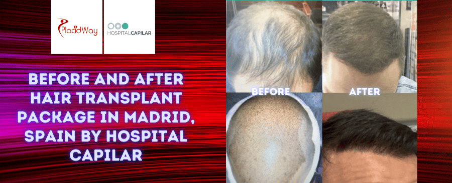 Paquete de trasplante de cabello FUE DHI antes y después en Madrid, España, por Hospital Capilar