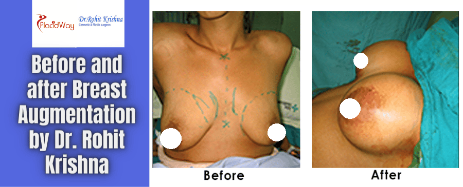 Breast Augmentation Before and After