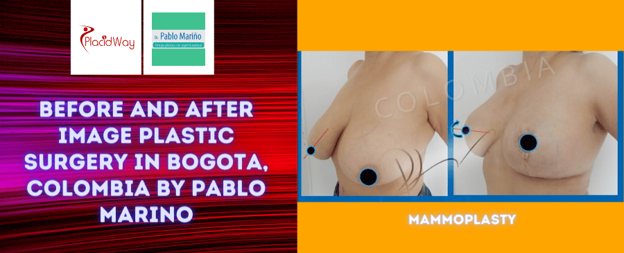 Before and After Image Plastic Surgery in Bogota, Colombia by Pablo Marino