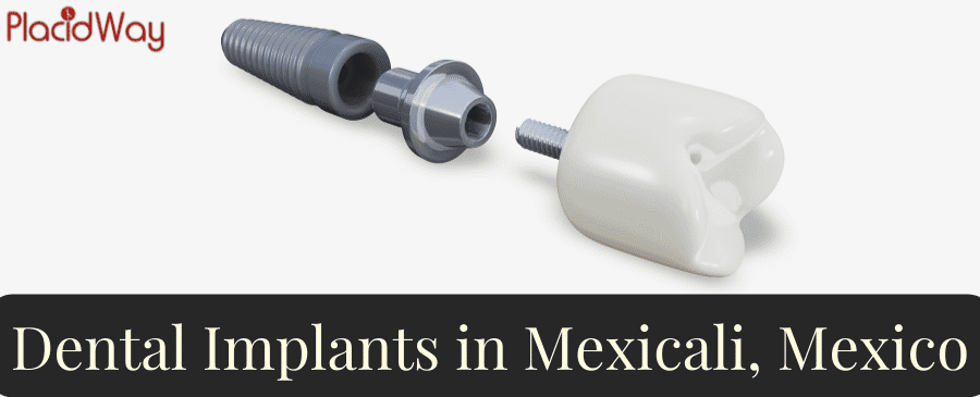 All-Inclusive Dental Implants in Mexicali, Mexico