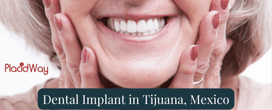 Dental Implant in Tijuana, Mexico