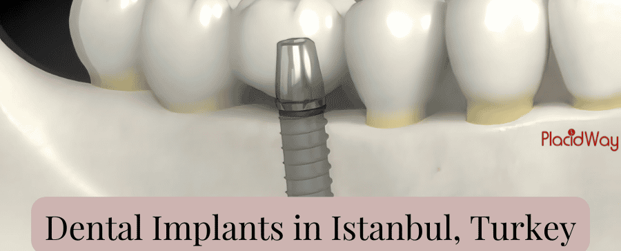 Best Dental Implants in Istanbul Turkey Prices