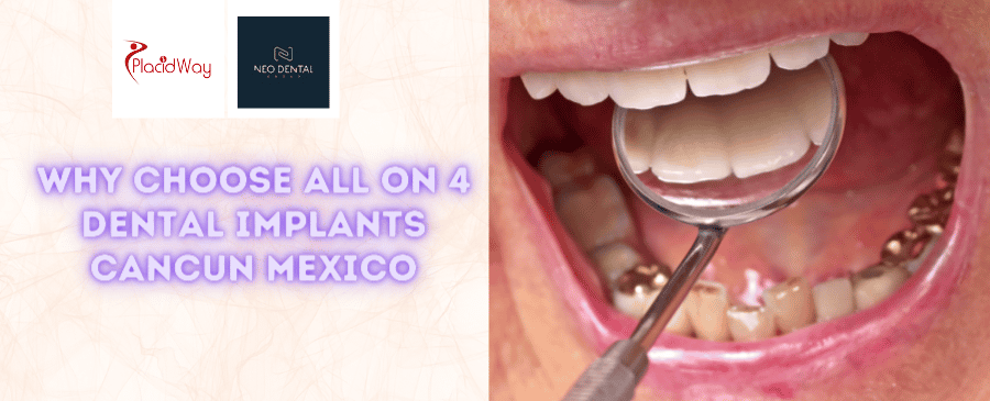 Best Package for All on 4 Dental Implants in Cancun Mexico