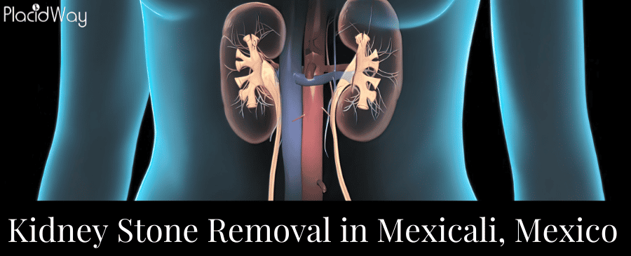 Kidney Stone Removal in Mexicali, Mexico
