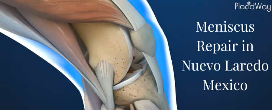 Meniscus Repair in Nuevo Laredo, Mexico