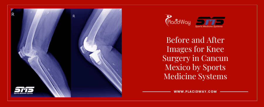 Before and After Orthopedic Surgery in Mexico