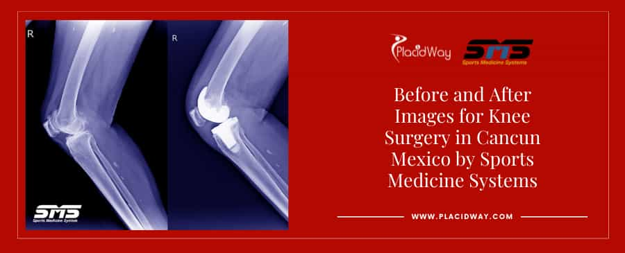 Before and After Orthopedic Surgery in Mexico