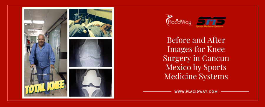 Before and After Orthopedic Surgery in Mexico