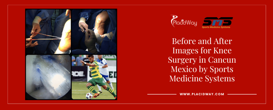 Before and After Orthopedic Surgery in Mexico