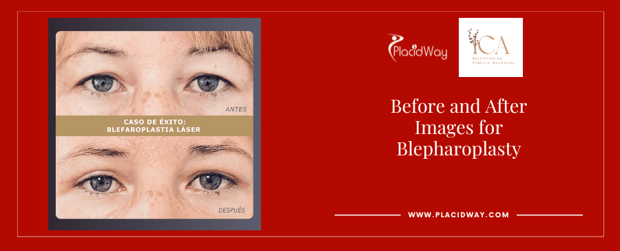 Before and After Images Blepharoplasty