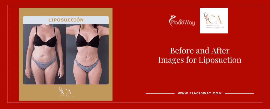 Before and After Images Liposuction