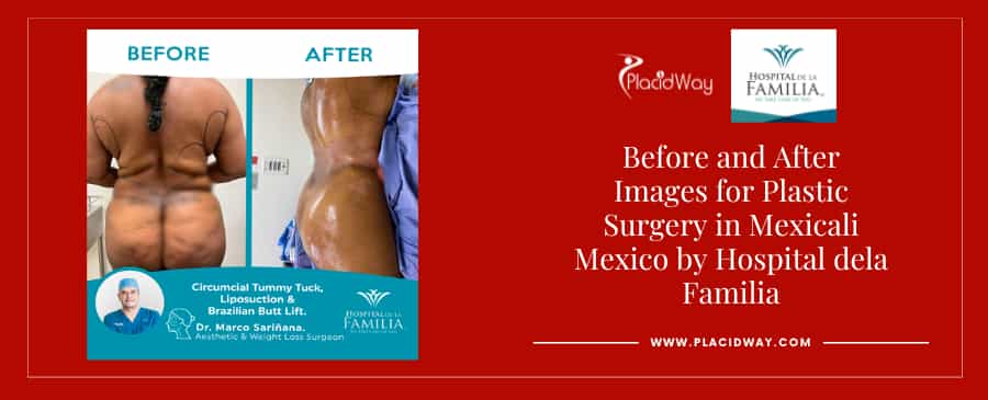 Before and After liposuction in Mexicali, Mexico