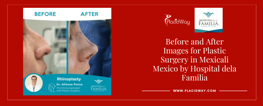Before and After rhinoplasty in Mexicali, Mexico