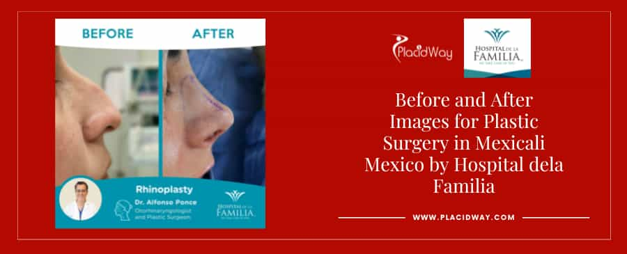 Before and After rhinoplasty in Mexicali, Mexico