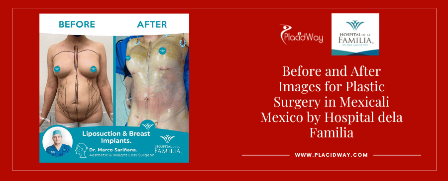 Before and After liposuction and breast implants in Mexicali, Mexico