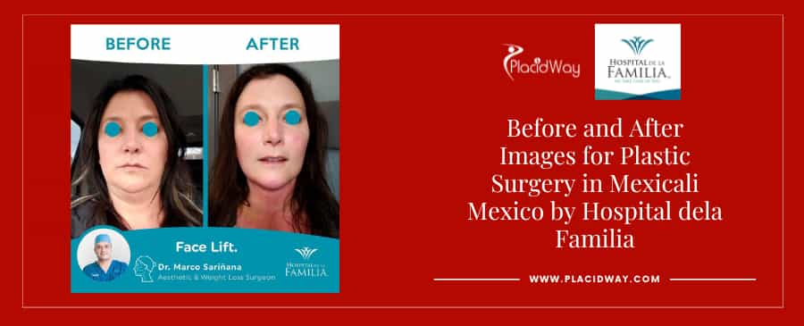 Before and After Facelift in Mexicali, Mexico