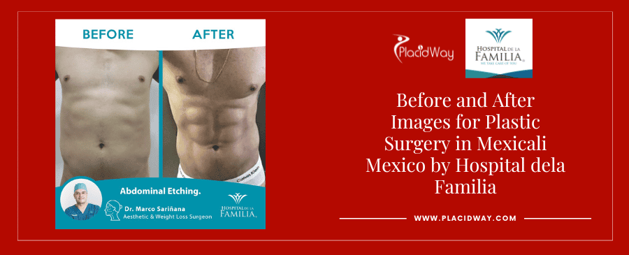 Before and After Abdominal etching in Mexicali, Mexico