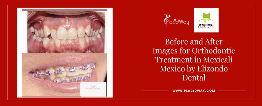 Fotografías de antes y después de atención dental en Mexicali, México, por EDG