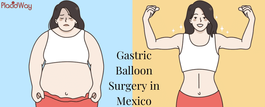 Gastric Balloon Surgery in Mexico