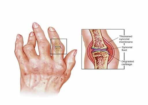 Stem Cells Therapy for Rheumatoid Arthritis in Gujarat India