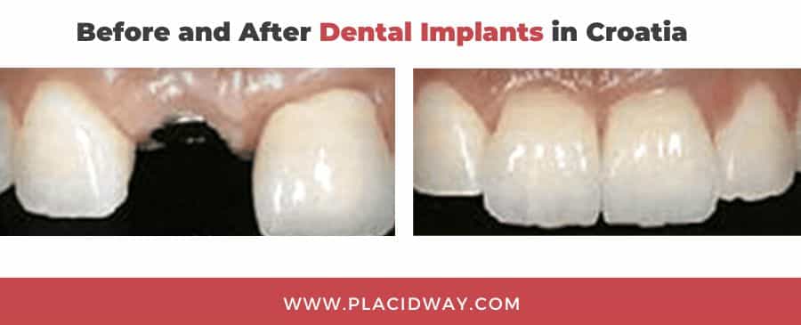Before and After Dental Implants in Croatia