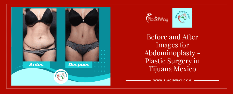 Before and After Tummy Tuck in Tijuana Mexico
