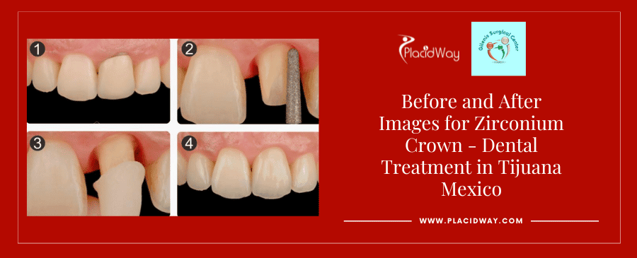 Before and After Dental Crown in Tijuana Mexico