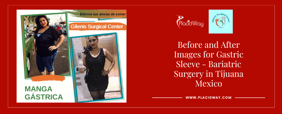 Before and After Gastric Sleeve in Tijuana Mexico