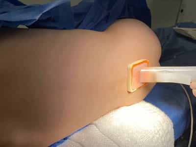 Image Stem Cell for Autism in Mexico - Stem Health