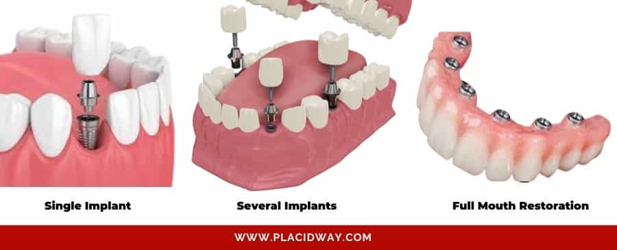 Options for Tooth Implants in Mexico
