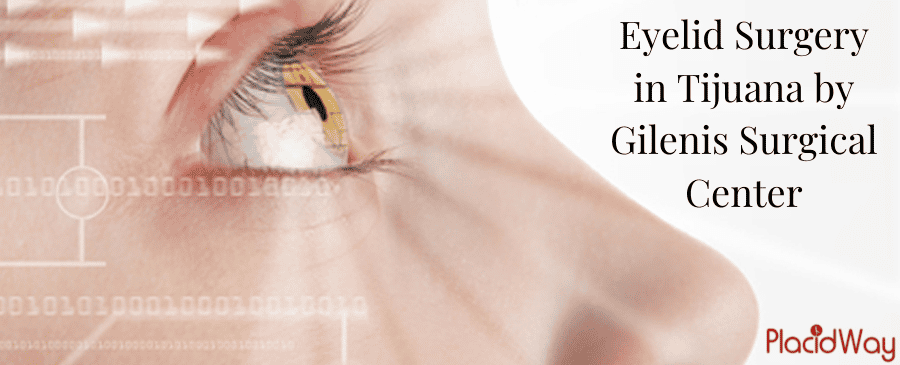 Eyelid Surgery in Tijuana