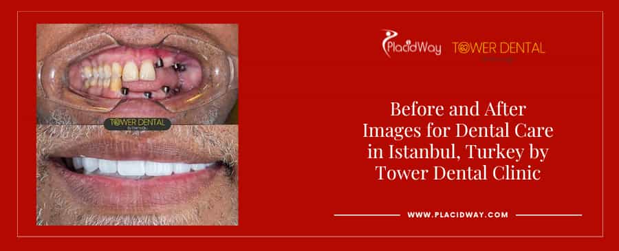 Before and After Dental Implants in Istanbul Turkey