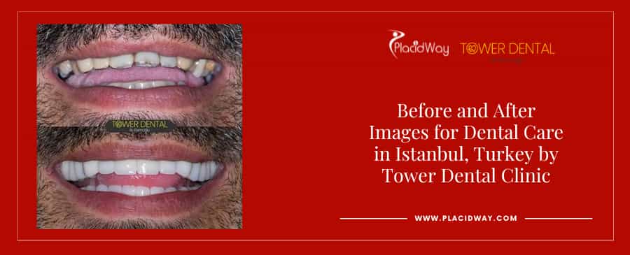 Before and After Dental Crowns in Istanbul Turkey