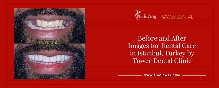 Before and After Smile Makeover in Istanbul Turkey