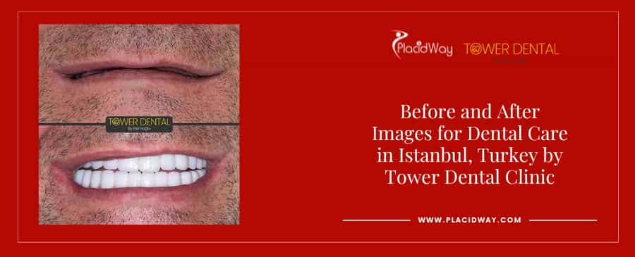 Before and After Dental Veneers in Istanbul Turkey