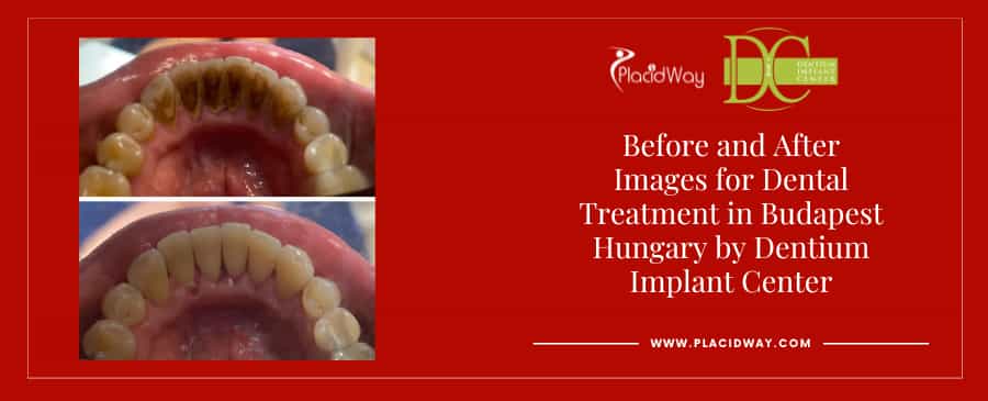 Before and After Images for Dental Treatment in Budapest Hungary